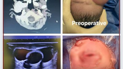 بالتفاصيل.. فريق طبي ينجح في استئصال ورم نادر من عين رضيعة بمستشفى جامعة عين شمس