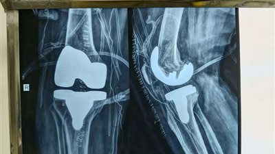 إنجاز طبي في المنوفية.. فريق جراحي ينقذ سيدتين ويعيد لهما الأمل  ( تفاصيل وصور )