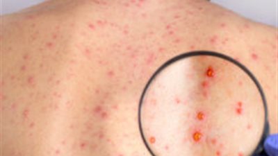 معلومات عن مرض الهربس.. عدوى فيروسية شائعة تصيب الأطفال