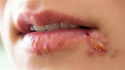 ما هو مرض الهربس؟.. أعراضه وعلاجه وكيفية الوقاية منه