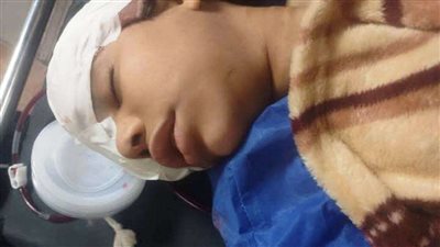 التفاصيل الكاملة لطفلة القطار بالمنوفية بعد فقدها لعينها ( صور )