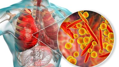ما هي بكتيريا الميكوبلازما التي حذرت منها الصحة العالمية؟ .. وهل نشهد وباءً عالمياً جديدًا؟