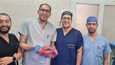 يزن 2 كيلو جرام.. فريق طبي بأسيوط ينجح في استئصال طحال متضخم