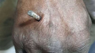 فريق طبي بمستشفى دسوق ينجح في استخراج سيخ حديد من يد عامل حداد