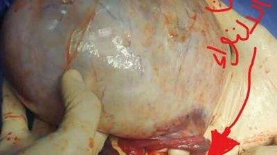 إنقاذ ثلاثينية بتدخل جراحي عاجل بالمنوفية (تفاصيل وصور)