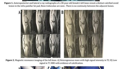 مستشفى شبين الكوم للجراحات المتخصصة يسجل حالة نادرة لورم في الركبة