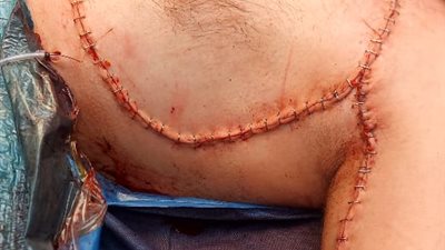 إنقاذ ذراع مريض بجراحة معقدة للأعصاب الطرفية والضفيرة العضدية