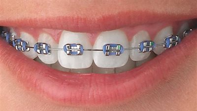 تقويم الأسنان| خطوات التركيب وأسرار الألوان التي تعكس ذوقك