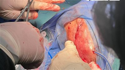 فريق طبي بمستشفى قويسنا المركزي ينجح في إنقاذ حياة مريض بعد جراحة دقيقة بالمخ