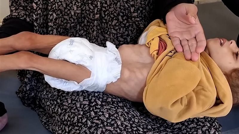 تفاقم سوء التغذية
