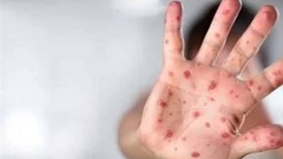 «المنوفية» تُعلن النصر على الجدري المائي وانتظام تام في الدراسة