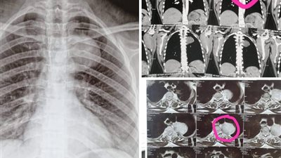 نجاح طبي بمستشفيات جامعة أسيوط: إنقاذ أم وجنينها في عملية دقيقة