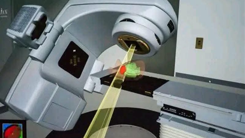 الجهاز الإشعاعي IMRT