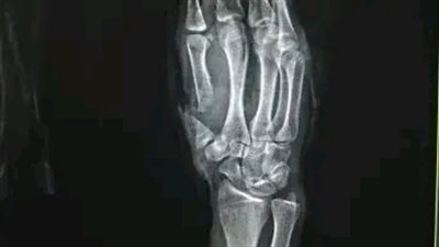 أعادوا إصبع الإبهام لشاب.. نجاح جديد لمستشفى سوهاج الجامعي بداية 2026