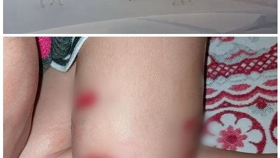 كلب مسعور يعقر طفلًا أثناء مروره مع والدته بحلوان