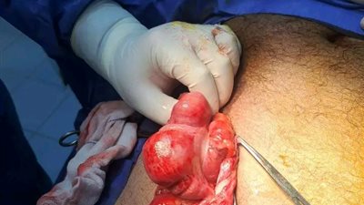 ‏صحة الدقهلية.. إنقاذ حياة مريض بفتق نادر خلال تدخل جراحي عاجل بمستشفى ميت سلسيل