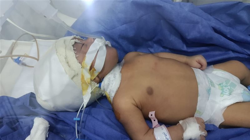 تركيب صمام مخ خارجي