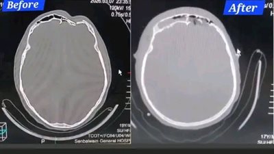 إنقاذ مريض من كسر معقد بعظام الجبهة والوجه بمستشفى السنبلاوين العام