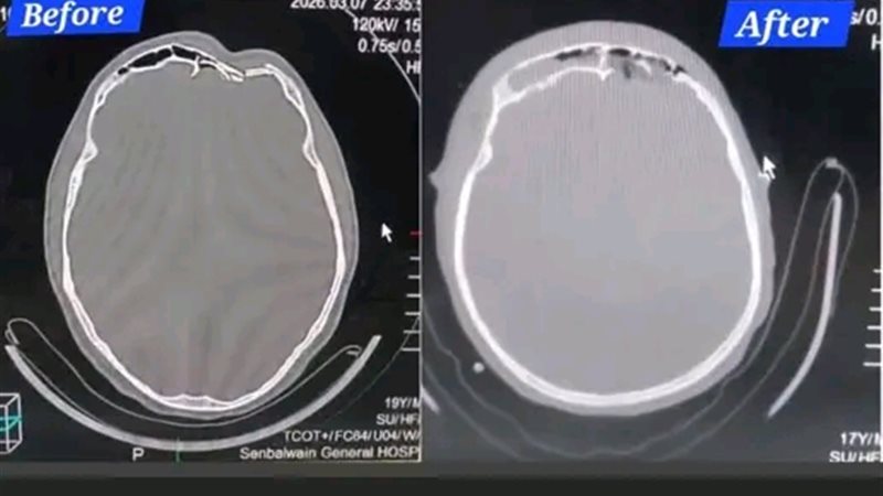 إنقاذ مريض من كسر