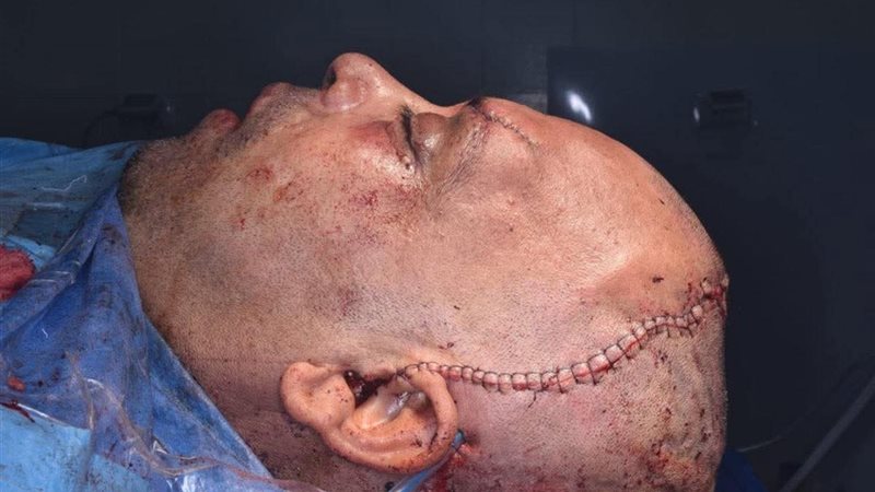 جراحة نادرة في شربين