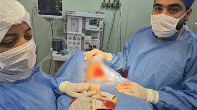 صحة الدقهلية: نجاح استئصال تضخم بالغدة الدرقية ممتد للتجويف الصدري بالجمالية المركزي