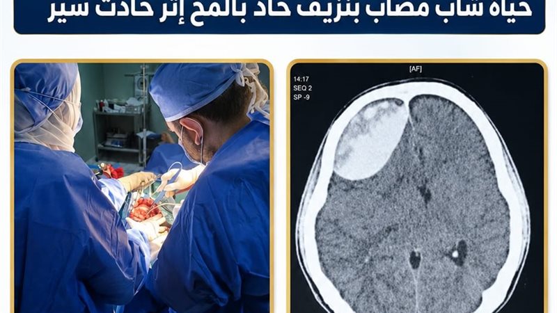 نجاح جراحة مخ وأعصاب