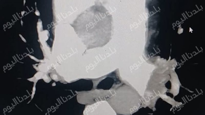 الاشعة 