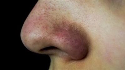 قبل تجربة المواد الكيميائية.. طرق بسيطة للتعامل مع اسمرار المنطقة حول الأنف